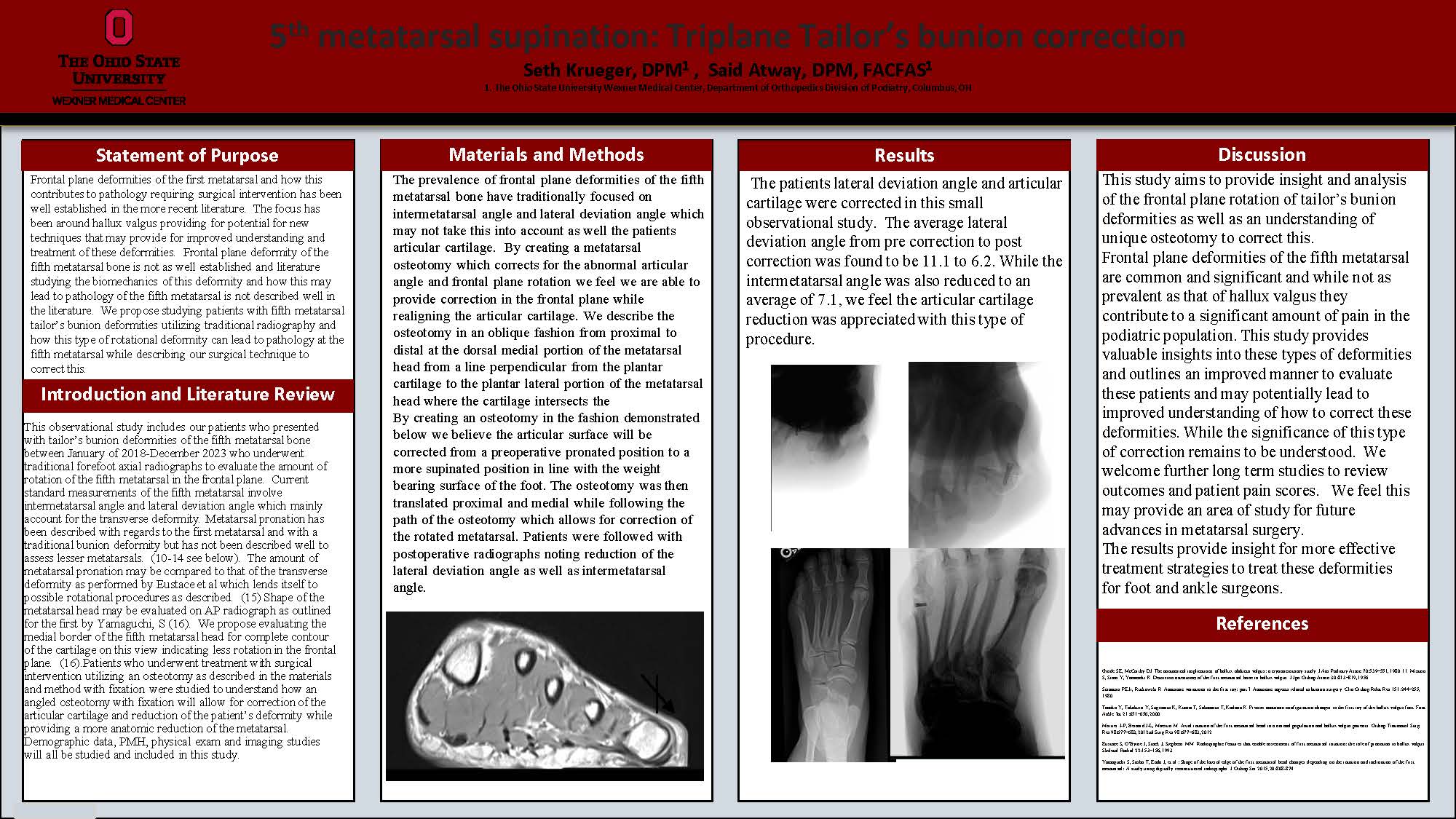 A Novel Case Study of an Eccrine Porocarcinoma of the Toe